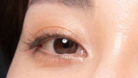 blepharoplasty